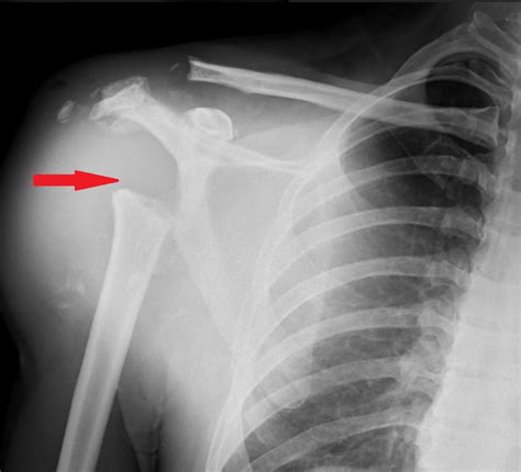 Charcot Joint Shoulder