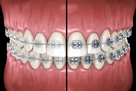 Ceramic Braces in Toronto | Atlas Dental