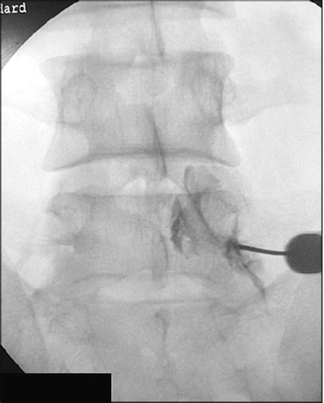 Image result for Selective Nerve Root Block Contrast Spread Pattern