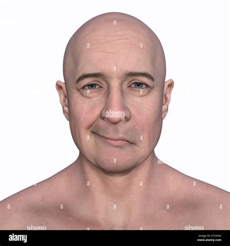 Facial paralysis stroke hi-res stock photography and images - Alamy