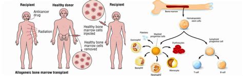 Bone Marrow Transplant In India, Hospital For Bone Marrow Transplant