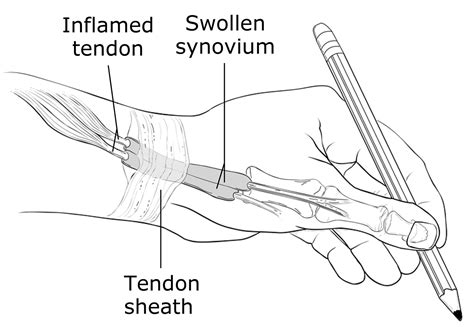 De Quervain’s Tenosynovitis - Causes, Symptoms, Test, Exercise, Surgery