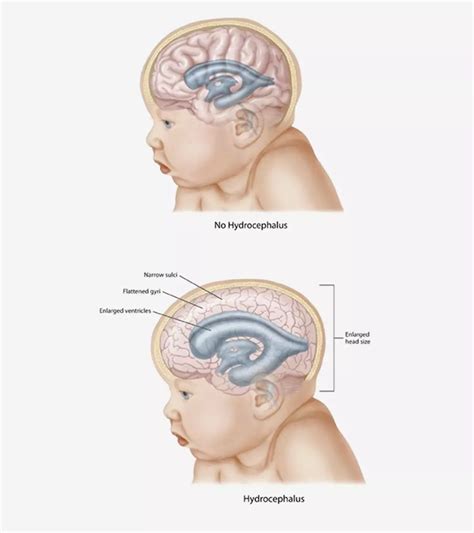 Baby Seizures: Signs, Causes, And Treatment