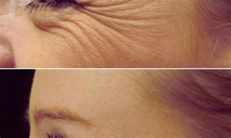 Combining Botulinum Toxin and PDO Threads Offers Effective Solution for ...