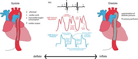 The Intra-aortic Balloon Pump: A Focused Review of Physiology, Transport Logistics, Mechanics ...