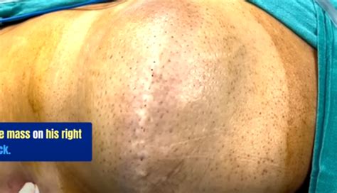 Image result for Painful Giant Abscess Exploding