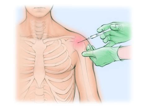 Image result for Back Arthrogram Technique