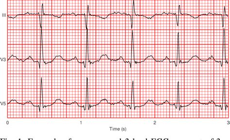 Image result for Pacemaker Programming