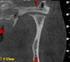 Healing joints with precision: The role of prolotherapy in treating TMD ...
