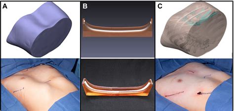 Customized Three-Dimensional Printed Nuss Bar Molds for Repair of ...