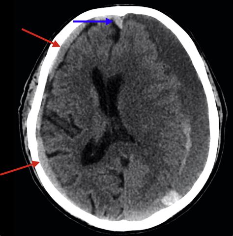 Imaging of Subdural Hematomas - Neurosurgery Clinics