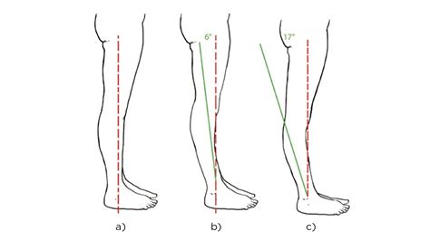 I Hyperextend My Knees: Is This Bad? (Probably Not.)