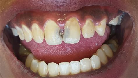 Front Tooth Cavity Filling