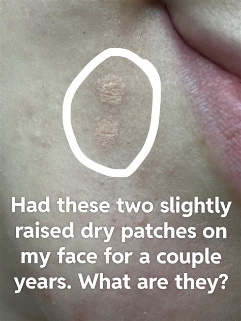 Why Won't The Bumps On My Face Go Away at Larry Childs blog