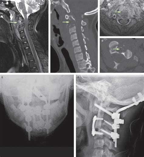 Part II: Spinal-cord neoplasms—primary tumours of the bony spine and ...