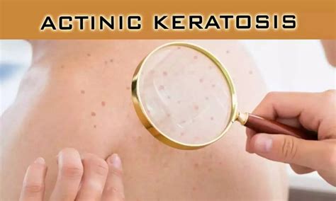 Immune Checkpoint Inhibitors for Cancer Treatment Tied to Significant ...