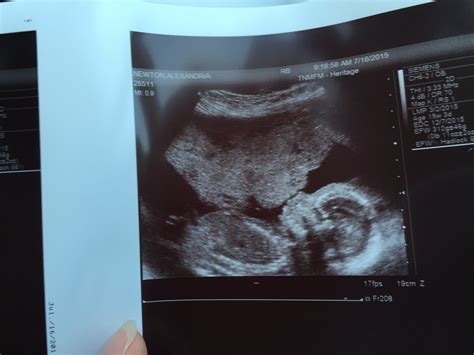20 week/Anatomy Scan Ultrasound Thread - Page 2 — The Bump
