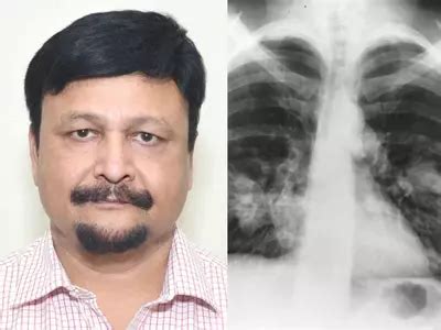 COVID-19 Will Be Detected In 3-5 Seconds With IIT Roorkee Prof's X-Ray ...