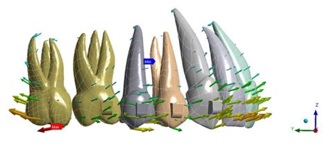 Upper Second Molar Distalization with Clear Aligners: A Finite Element ...