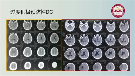 一例重型颅脑损伤患者的综合治疗丨颅脑创伤-神经重症病例周刊（105期）