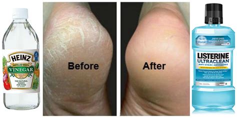Cracked Heels Before And After