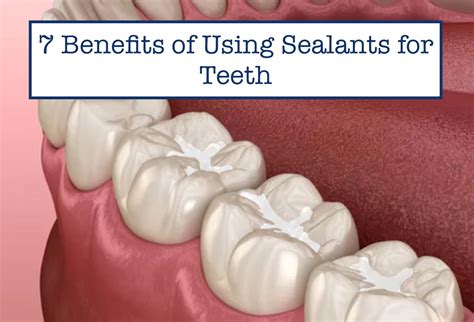 7 Benefits of Using Sealants for Teeth – B.WEISS Health