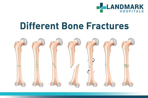 Broken Bone Versus Fracture: What Is The Difference? – IEYHQ