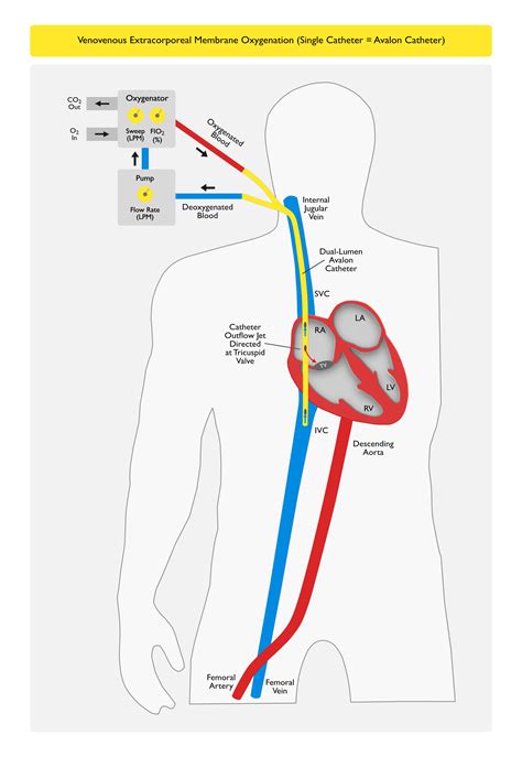 Vv Ecmo Extracorporeal Membrane Oxygenation (VA ECMO) In Management Of
