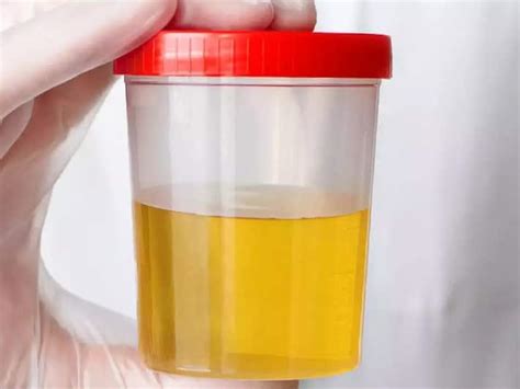 किडनी डैमेज होने पर यूरिन में दिखने लगते हैं ये 5 लक्षण, गलती से भी न ...