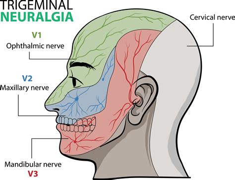 Trigeminal Neuralgia: Causes, Triggers, and Treatments