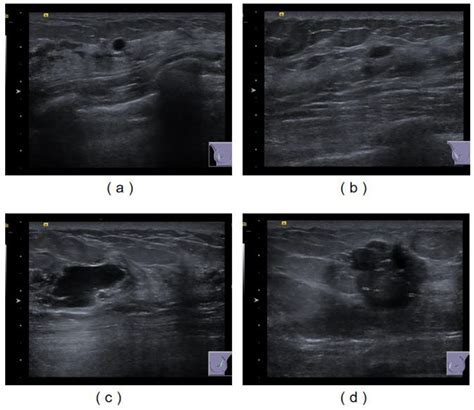 Rapid Segmentation and Diagnosis of Breast Tumor Ultrasound Images at the Sonographer Level ...