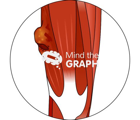 Image result for Soft Tissue Sarcoma