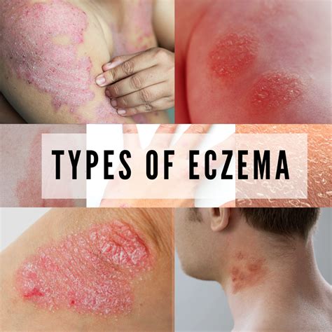 7 TYPES OF ECZEMA AND ITS SYMPTOMS - BANISH