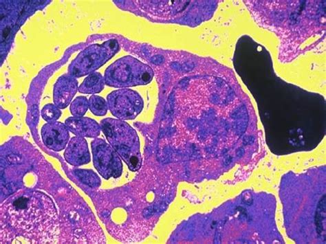 Image result for Genetic Polymorphism