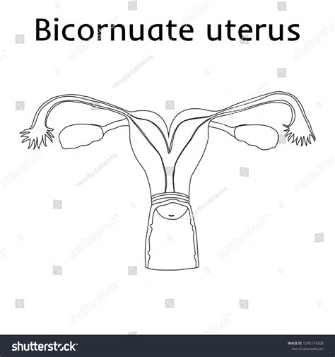 Heartshaped Becornuate Uterus Womb Uterine Abnormalities: เวกเตอร์สต็อก (ปลอดค่าลิขสิทธิ์ ...