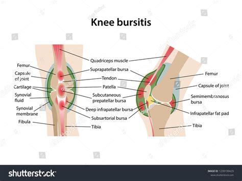 Bursitis of the knee joint with main parts - Royalty Free Stock Vector ...
