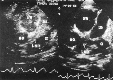 Kawasaki Disease Heart