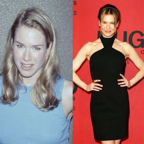 Stars Before & After Cosmetic Surgeries Pics | Stars Before & After ...