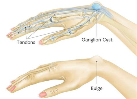 Ganglion Cyst Treatment | Hand Wrist Surgery — Galway Plastic Surgery
