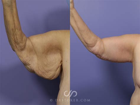 Arm Lift Surgery Cost Nz at Hugo Jenyns blog