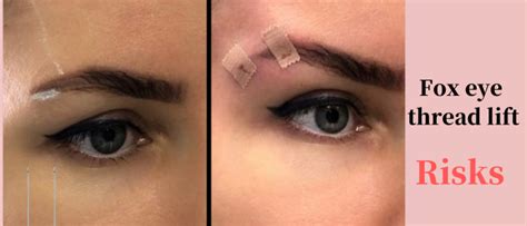 Image result for Fox Eye Thread Lift Procedure
