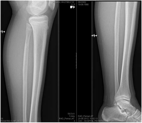 Proximal fibular stress fractures in children and adolescents, what ...