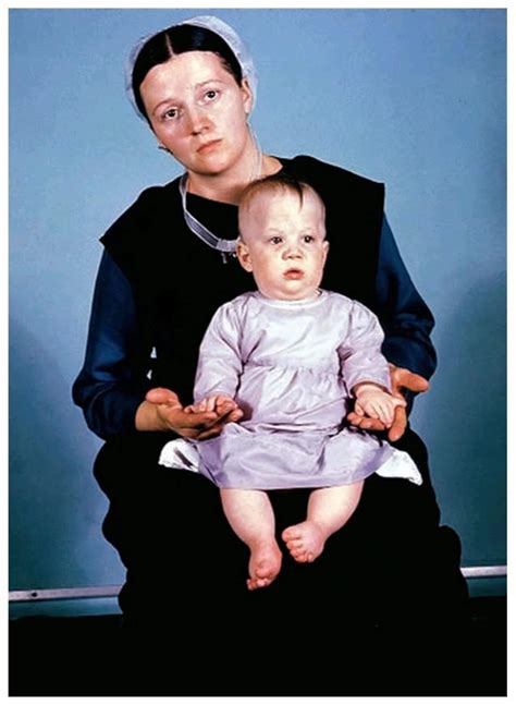 Hanaa Fayed on LinkedIn: Ellis–van Creveld syndrome‼️ An allele that ...