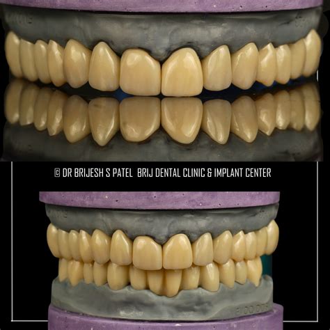 Treatment of Severely Attrited worn Teeth - Full Mouth Zirconia Crowns ...