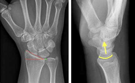 I Have A Broken Wrist: A Primer on Distal Radius Fracture Surgery — Dr. Nick Golinvaux