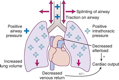 Mechanical Ventilation - Clinical Tree