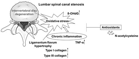 Potential Involvement of Oxidative Stress in Ligamentum Flavum Hypertrophy