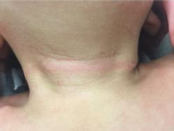 Accidental strangulation: a rare but potential risk of co-sleeping ...