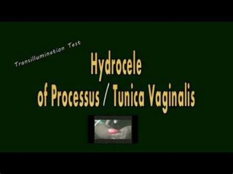 Image result for Transillumination Test Testis