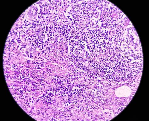 Pilonidal Sinus Laser Treatment | Apex Hospitals